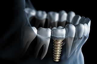 Diagram of an integrated dental implant in Fort Worth
