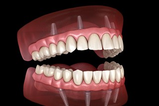All-On-4 dental implants