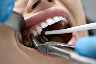 A dentist using forceps to extract a woman’s tooth