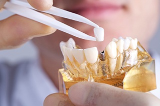 Implant dentist in Fort Worth placing restoration onto implant model