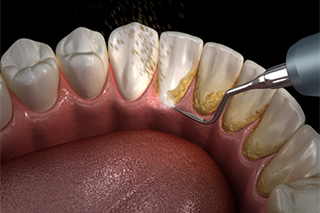  tartar removal