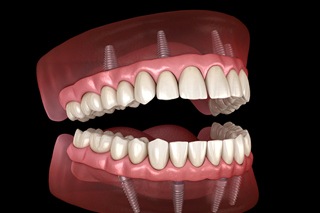 implant-retained denture