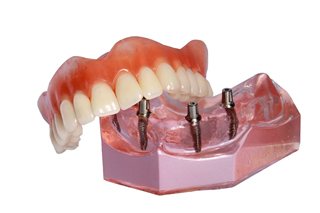 implant-supported denture