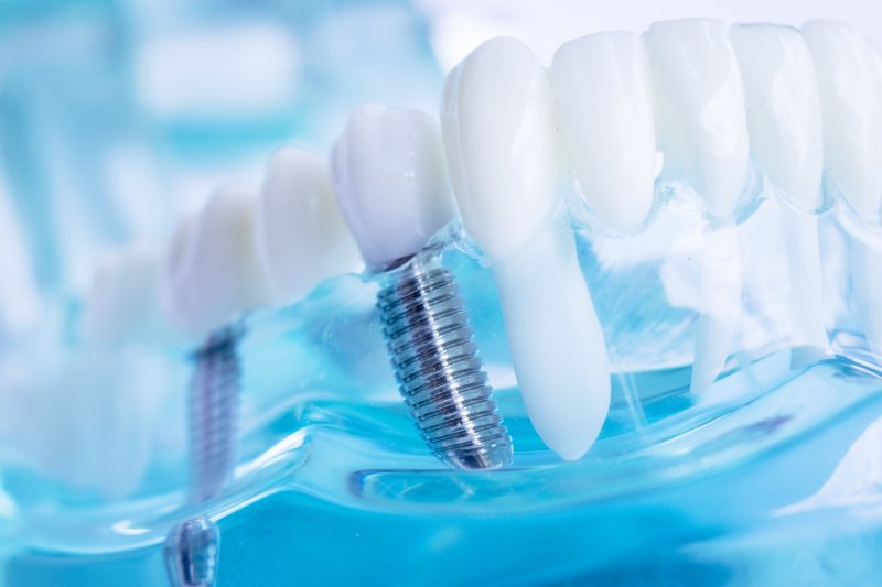 model of dental implants in Fort Worth