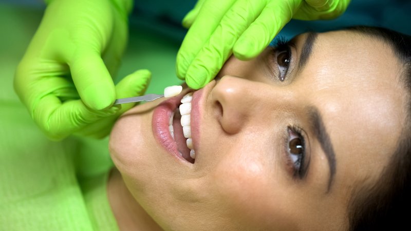 dentist attaching veneers to teeth in Fort Worth