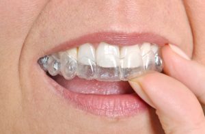 invisalign in fort worth tx is more efficient