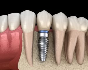 Model of bone density and dental implant success.