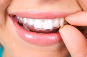 Invisalign in Fort Worth is easier to clean than other straightening treatments.