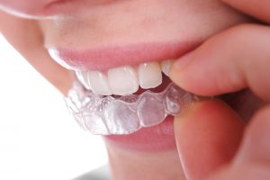 Learn why Invisalign from your dentist in Fort Worth is the optimal solution to straighten your teeth invisibly. 